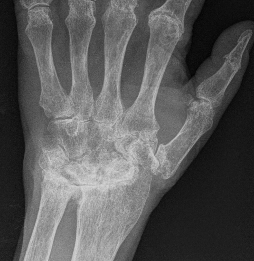 Rheumatoid Wrist